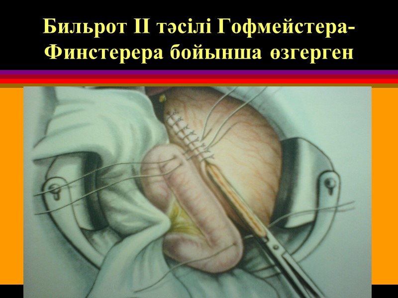 Бильрот II тәсілі Гофмейстера-Финстерера бойынша өзгерген